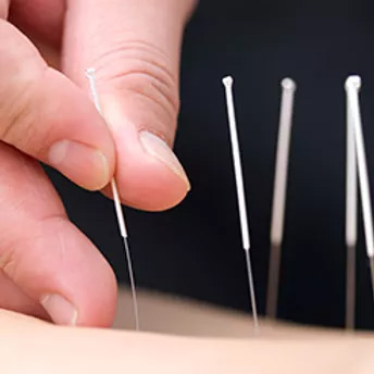 Acupuncture in Ilford
